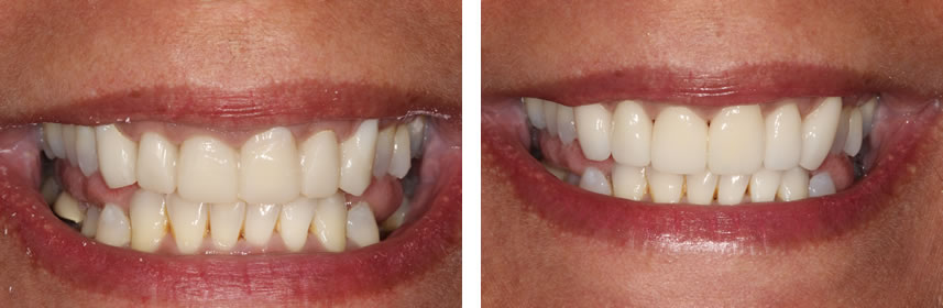 Crown Transformation